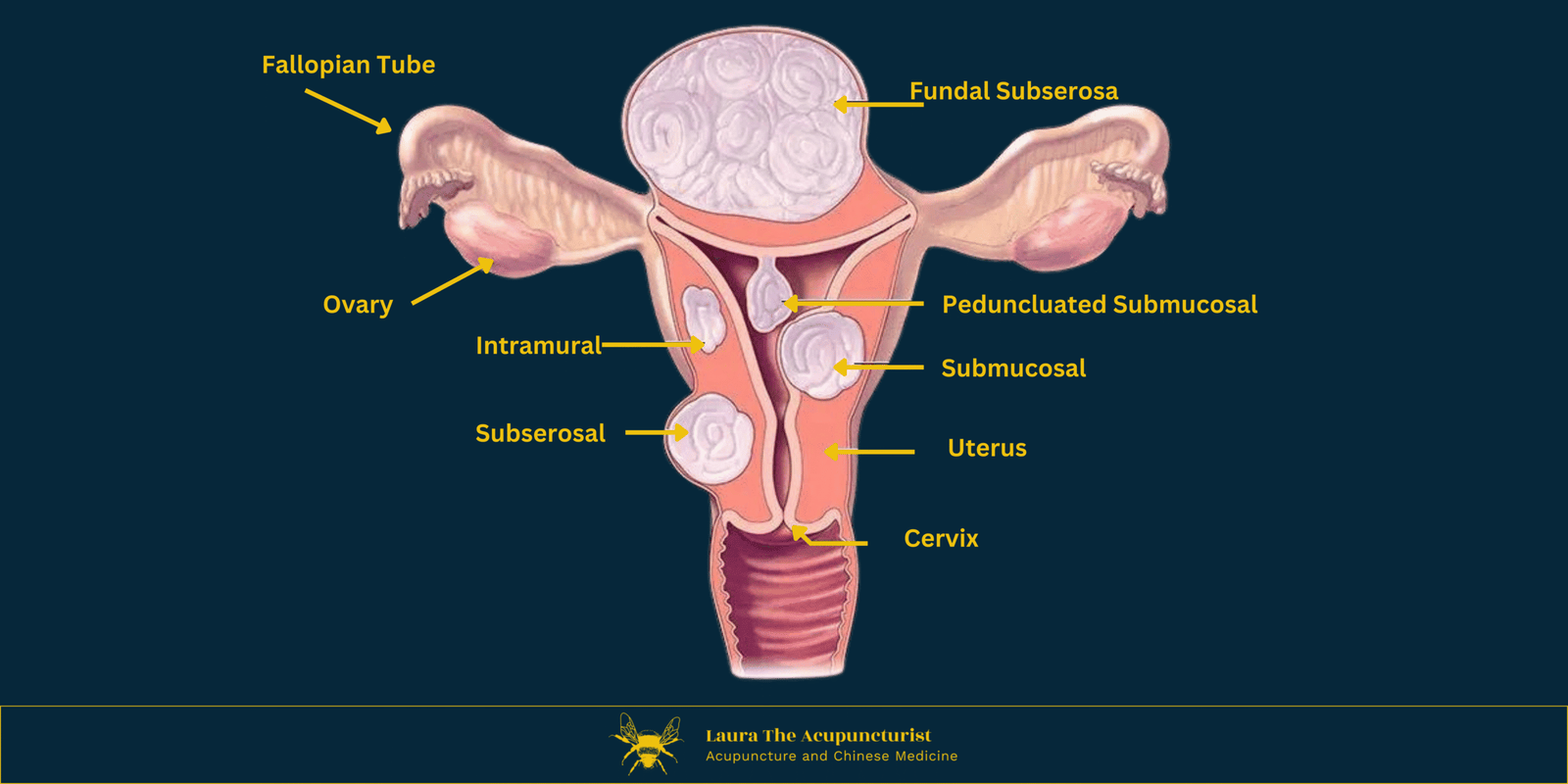 Fibroids: What Are They and How Can TCM Help?