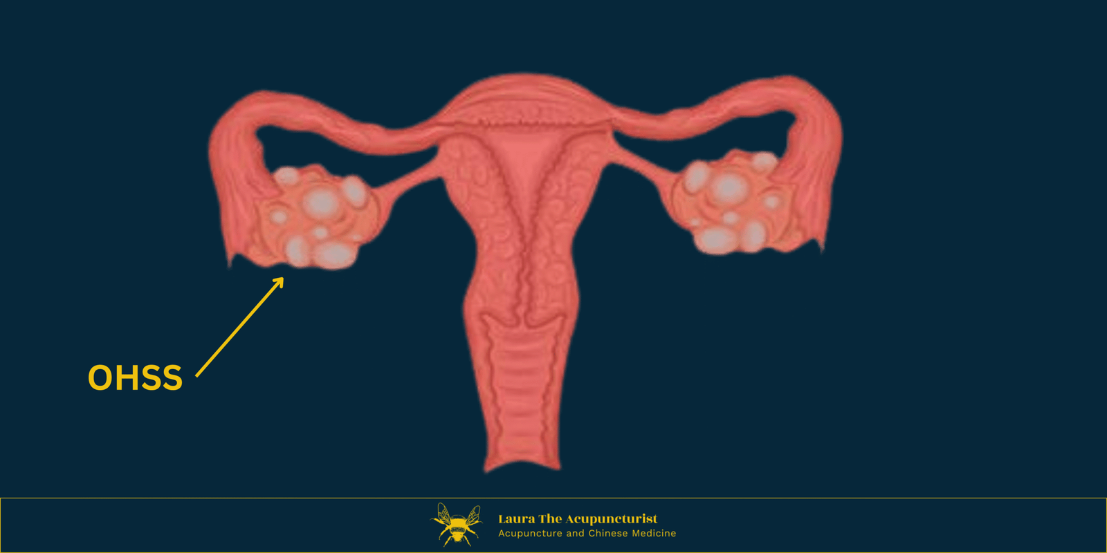 Ovarian Hyperstimulation Syndrome (OHSS)