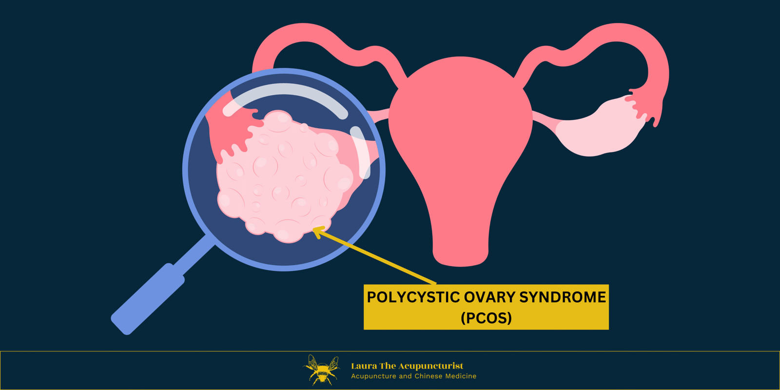 Polycystic Ovarian Syndrome (PCOS, now PMOS) and Thyroid Dysfunction