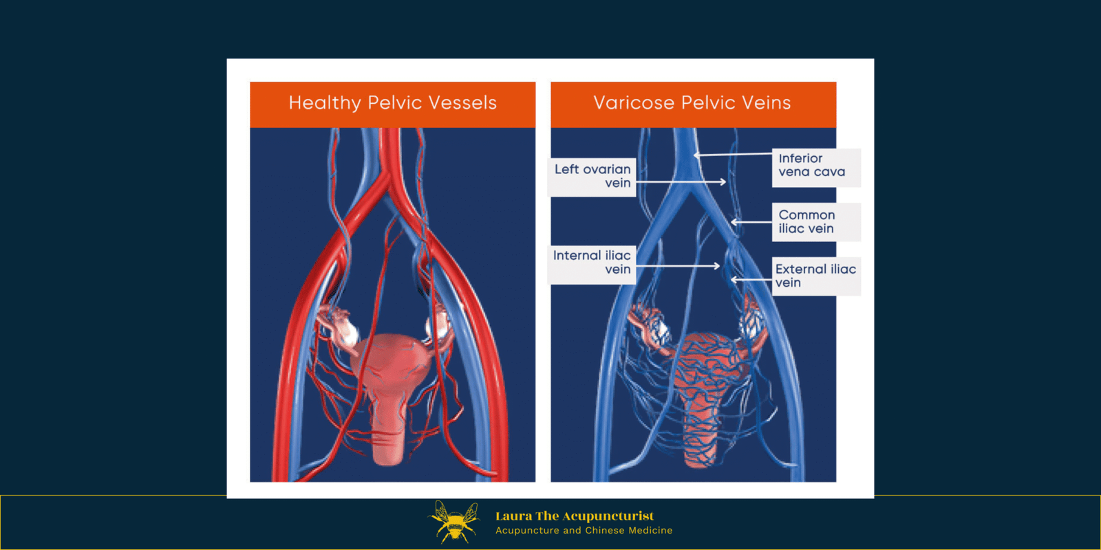 Pelvic Congestion Syndrome (PCS)