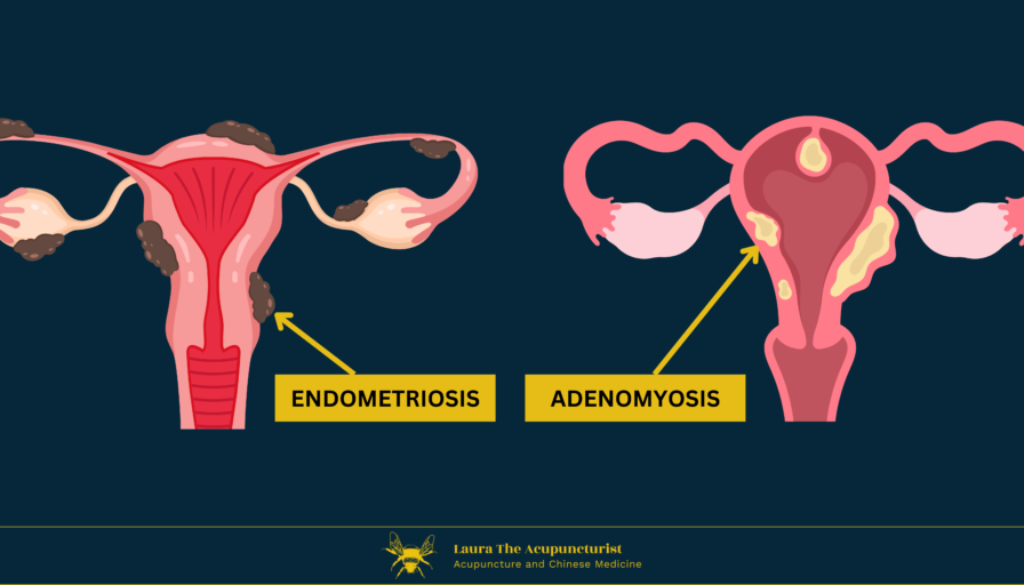 Endometriosis and Adenomyosis