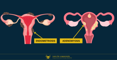 Endometriosis and Adenomyosis