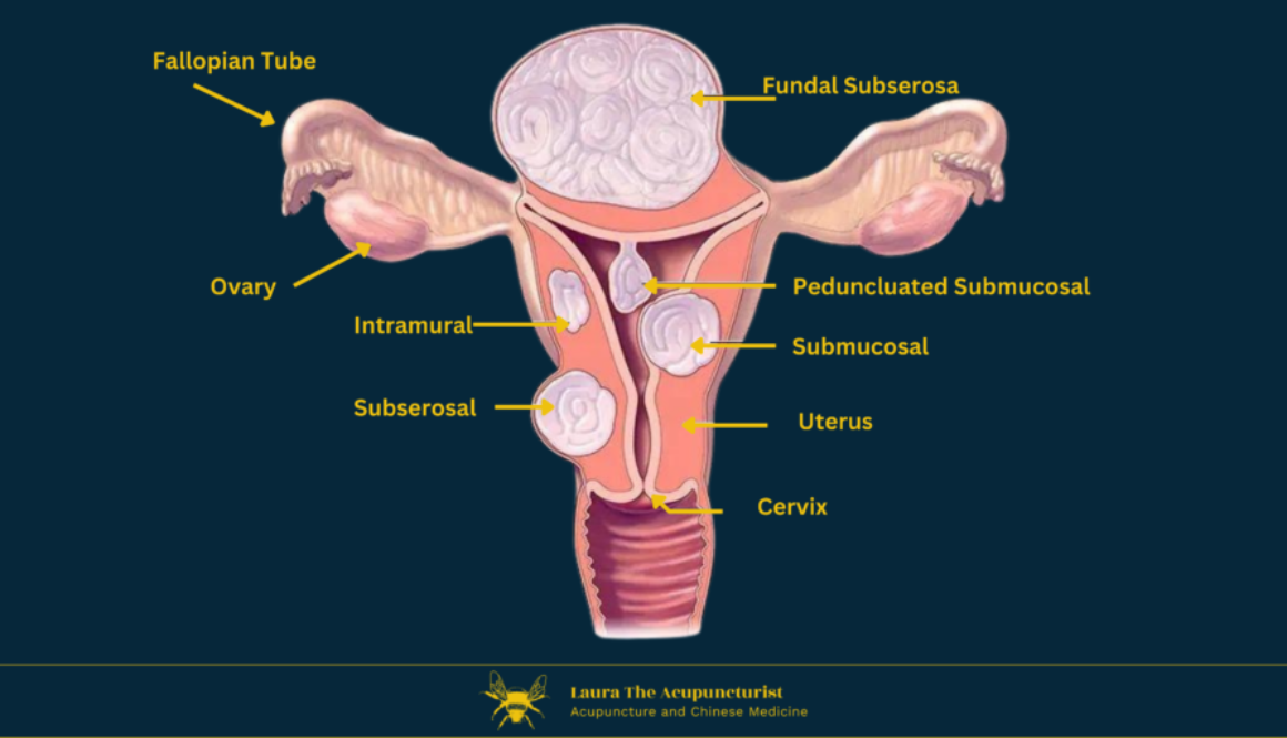 Fibroids