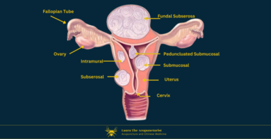 Fibroids