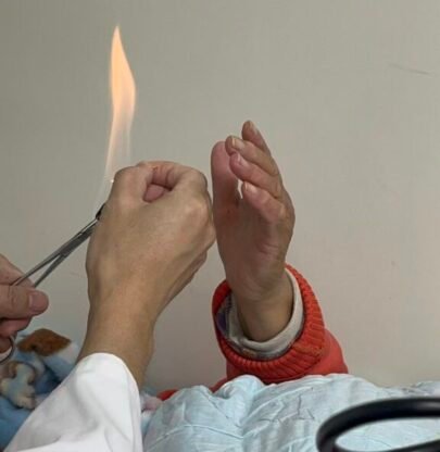 Fire needling