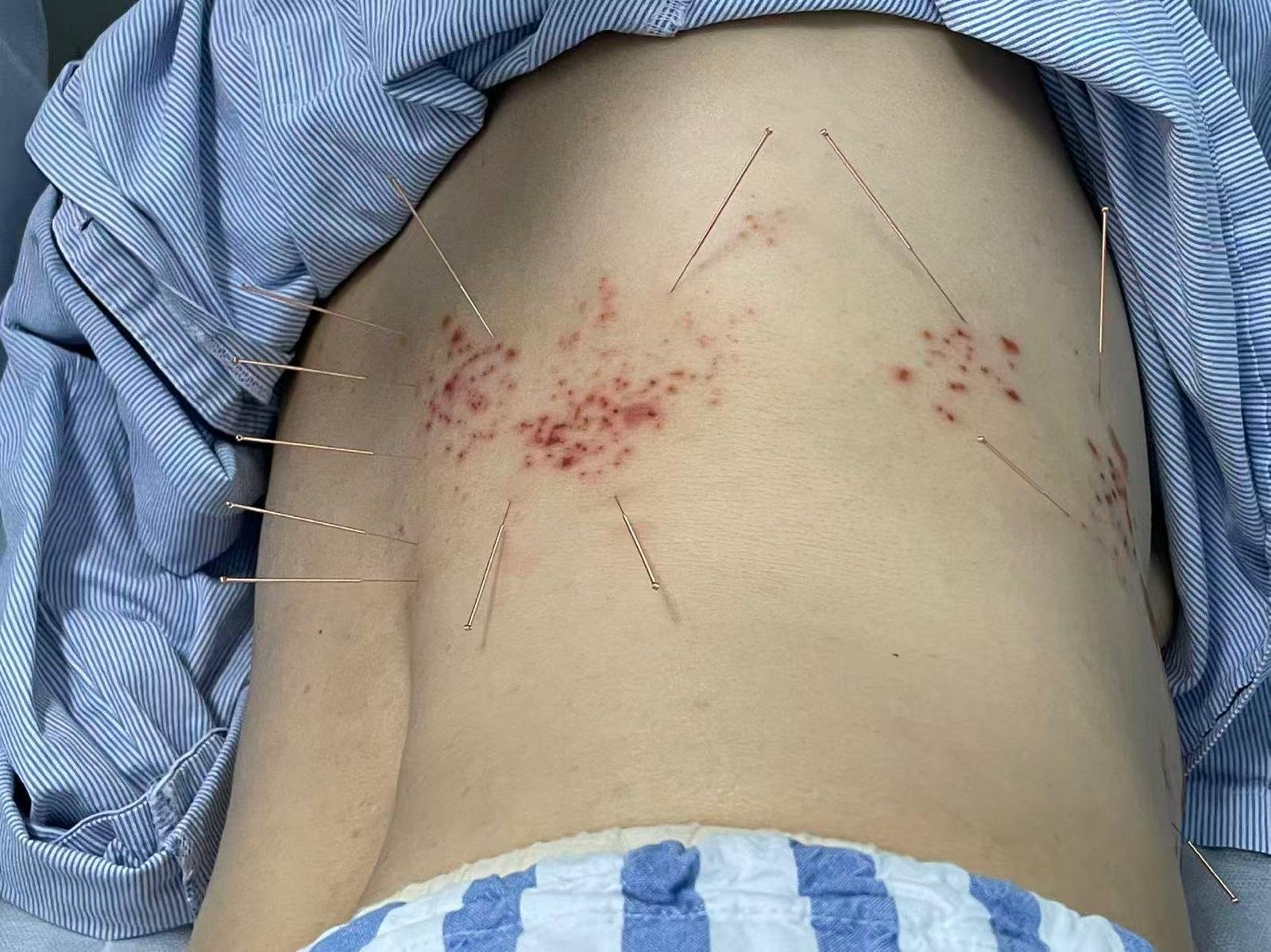 Shingles